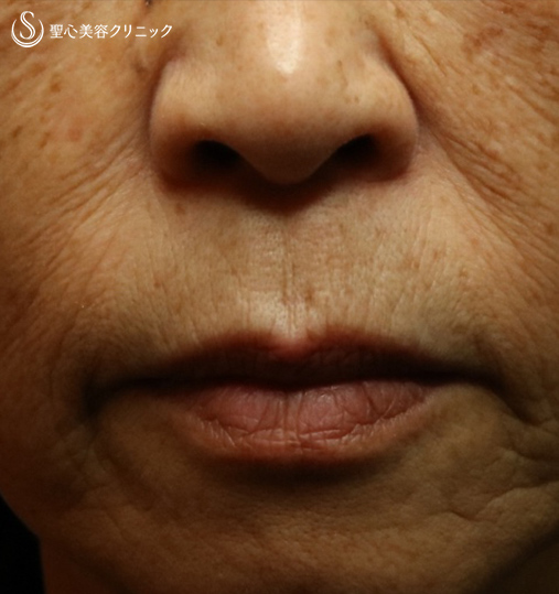 【70代女性・口周りのシワ】プレミムPRP皮膚再生療法（8ヶ月後） Before 