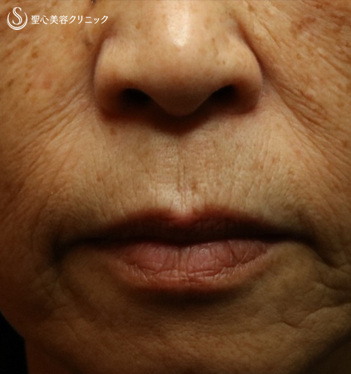 70代女性 口周りのシワ プレミムprp皮膚再生療法 8ヶ月後 症例写真 美容整形 美容外科なら聖心美容クリニック