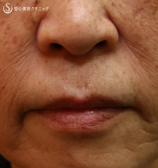【70代女性・口周りのシワ】プレミムPRP皮膚再生療法（8ヶ月後） After 