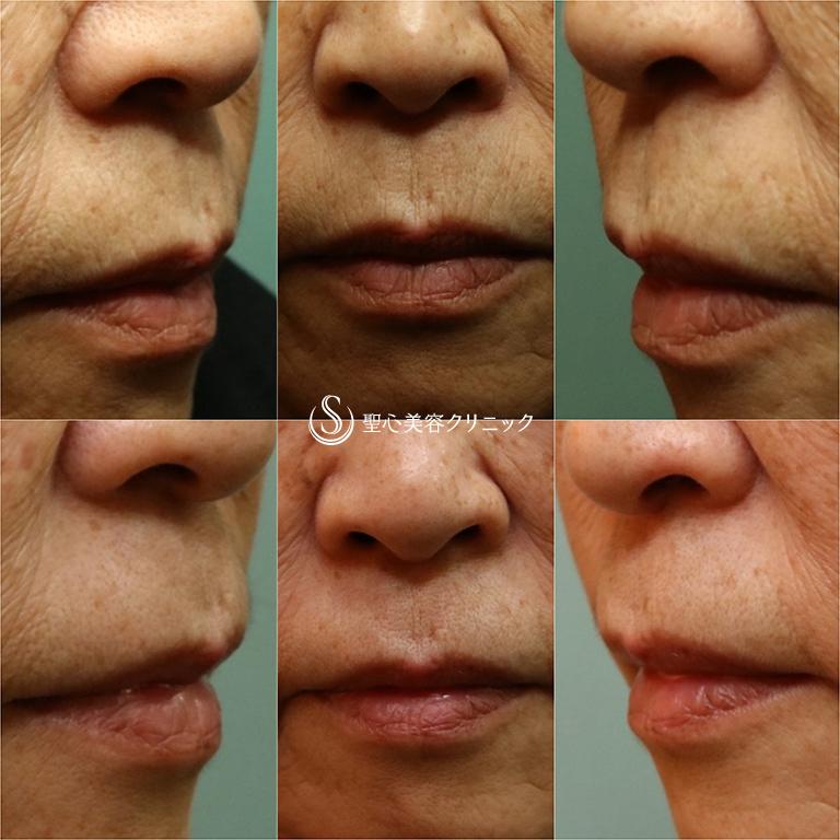 【70代女性・口周りのシワ】プレミムPRP皮膚再生療法（8ヶ月後） After 