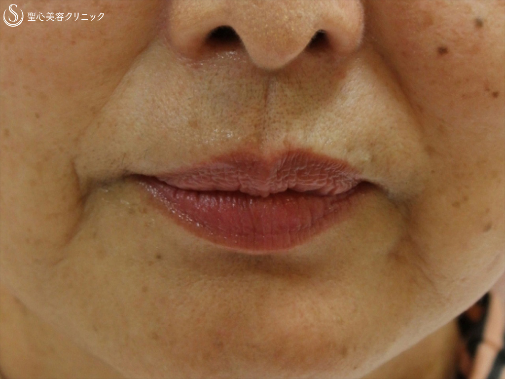 【60代女性・ほうれい線マリオネット線】プレミアPRP皮膚再生療法（4年後） Before 