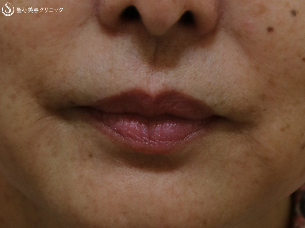 【60代女性・ほうれい線マリオネット線】プレミアPRP皮膚再生療法（4年後） After 