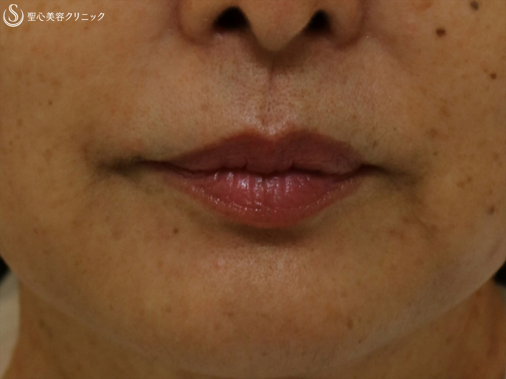 【60代女性・ほうれい線マリオネット線】プレミアPRP皮膚再生療法（4年後） After 