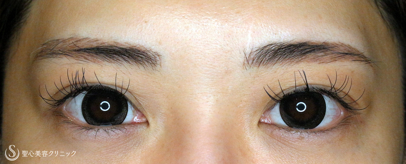 【30代女性・美容外科の二重＆眼瞼下垂】切らない眼瞼下垂+α＆マイクロメソッド+α（1年半後） After 
