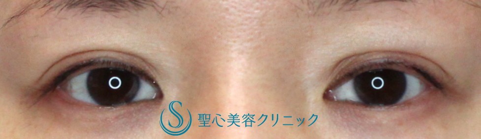 【30代女性・二重の幅を自然に広げて平行型に】二重埋没法（30日後） After 