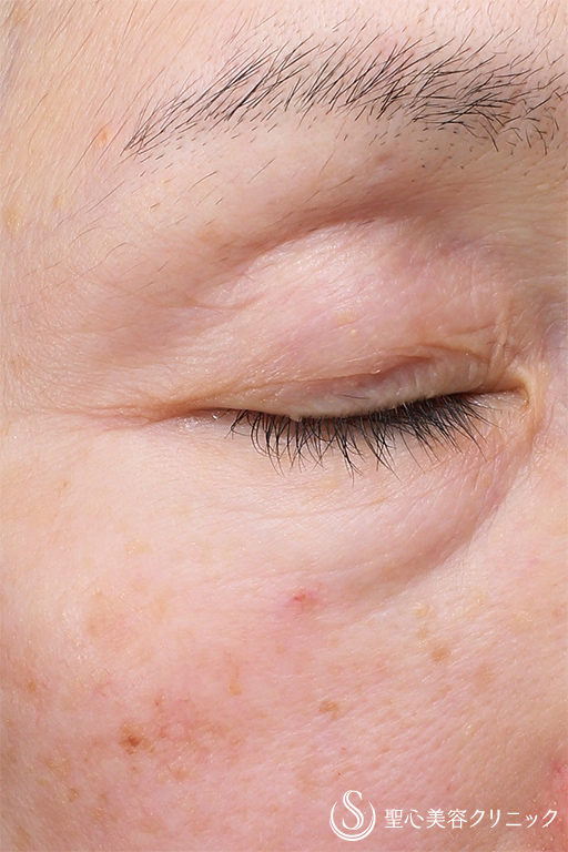 【50代女性・目の上と目の下とほうれい線】プレミアムPRP皮膚再生療法（5ヶ月後） Before 