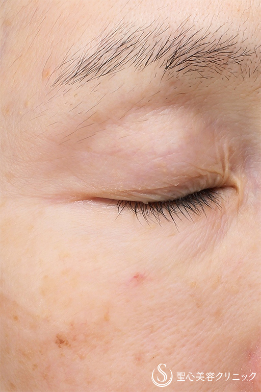 【50代女性・目の上と目の下とほうれい線】プレミアムPRP皮膚再生療法（5ヶ月後） After 