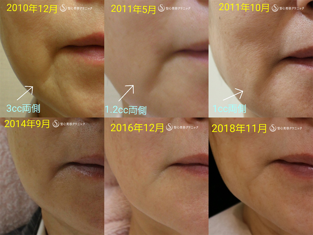 【60代女性・マリオネット線】プレミアムPRP皮膚再生療法（8年後） After 