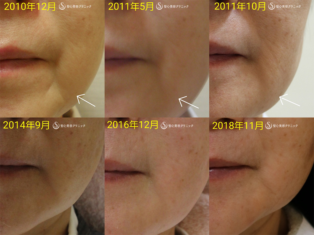 【60代女性・マリオネット線】プレミアムPRP皮膚再生療法（8年後） After 