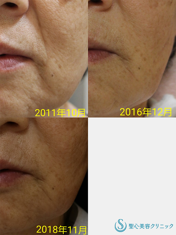 【70代女性・ほうれい線～マリオネット線】プレミアムPRP皮膚再生療法（7年後） After 
