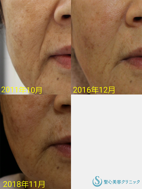 【70代女性・ほうれい線～マリオネット線】プレミアムPRP皮膚再生療法（7年後） After 