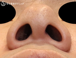 【20代男性・カッコイイお鼻に!!】鼻尖縮小＋鼻尖形成（耳介軟骨移植）（術後1ヶ月） Before 
