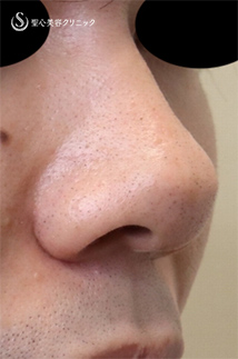 【20代男性・カッコイイお鼻に!!】鼻尖縮小＋鼻尖形成（耳介軟骨移植）（術後1ヶ月） Before 