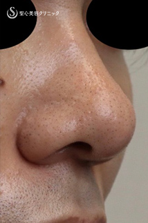 【20代男性・カッコイイお鼻に!!】鼻尖縮小＋鼻尖形成（耳介軟骨移植）（術後1ヶ月） After 