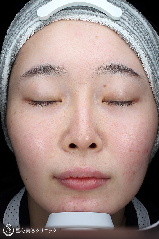 【20代女性・赤ら顔の治療】585 Quanta System Q1（照射後1ヶ月） After 