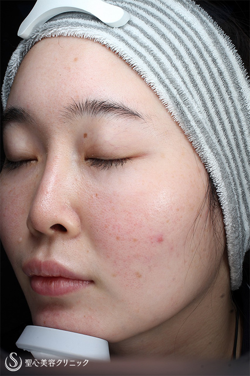 【20代女性・赤ら顔の治療】585 Quanta System Q1（照射後1ヶ月） After 