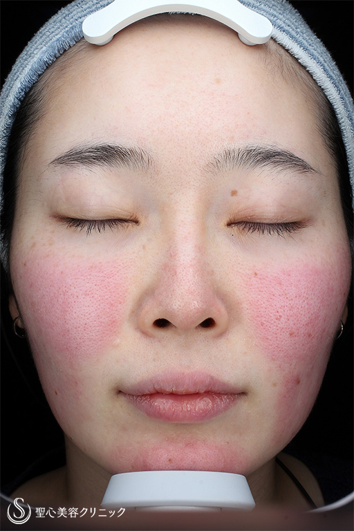 【20代女性・赤ら顔の治療】585 Quanta System Q1（照射後1ヶ月） Before 