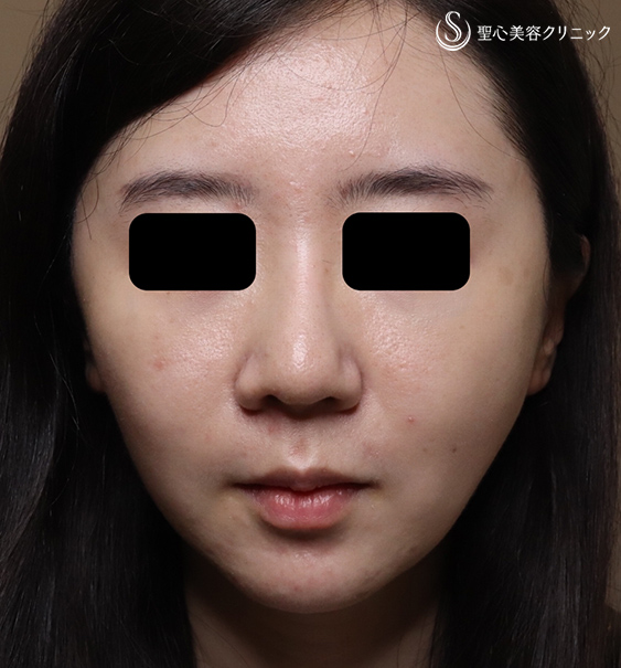 【30代女性・頬を引き締めスッキリ小顔】イントラジェン（処置後） Before 