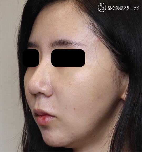 【30代女性・頬を引き締めスッキリ小顔】イントラジェン（処置後） After 