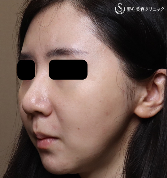 【30代女性・頬を引き締めスッキリ小顔】イントラジェン（処置後） Before 