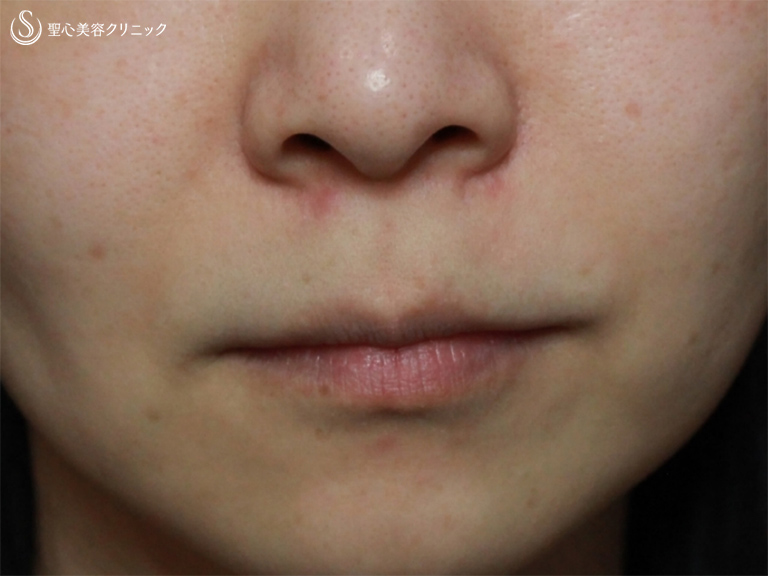 【30代女性・鼻から口元の印象の改善】小鼻縮小+リップリフト+プレミアムスマイル切開術（1ヶ月後） Before 
