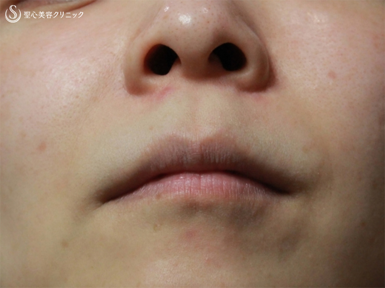 【30代女性・鼻から口元の印象の改善】小鼻縮小+リップリフト+プレミアムスマイル切開術（1ヶ月後） Before 