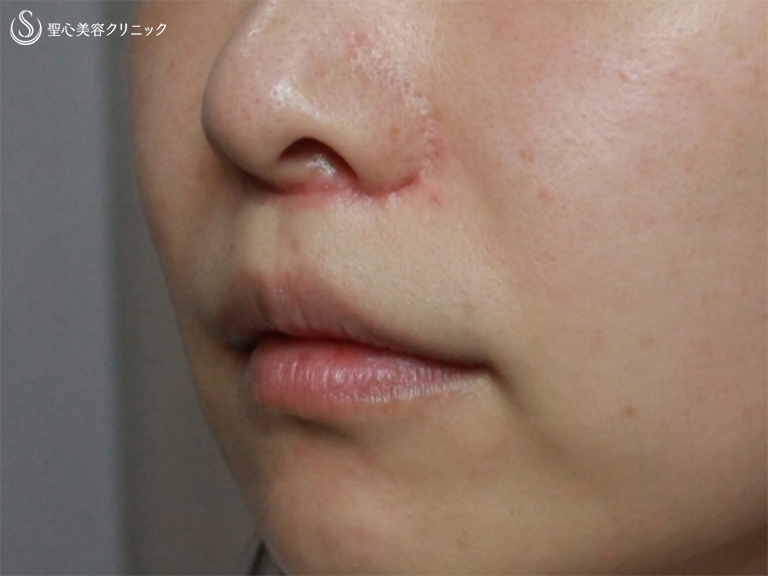 【30代女性・鼻から口元の印象の改善】小鼻縮小+リップリフト+プレミアムスマイル切開術（1ヶ月後） After 
