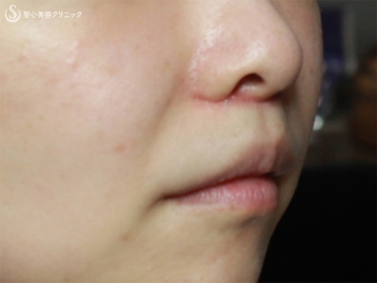 【30代女性・鼻から口元の印象の改善】小鼻縮小+リップリフト+プレミアムスマイル切開術（1ヶ月後） After 