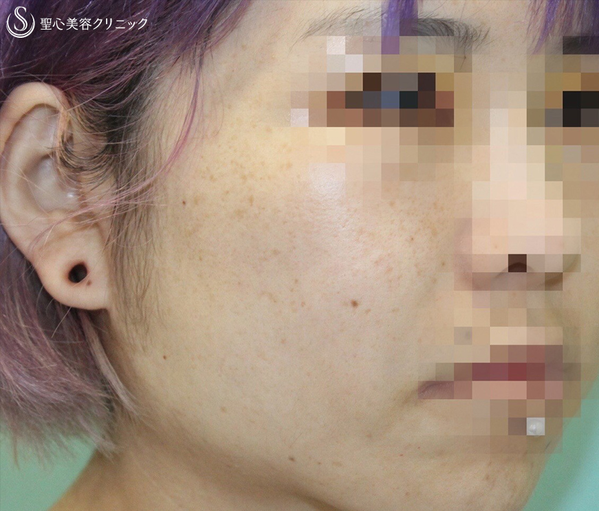 【30代女性・頬のタルミ＆フェイスラインをスッキリ】フェイスリフト（術後3ヶ月） After 