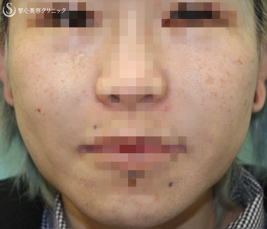 【30代女性・頬のタルミ＆フェイスラインをスッキリ】フェイスリフト（術後3ヶ月） Before 