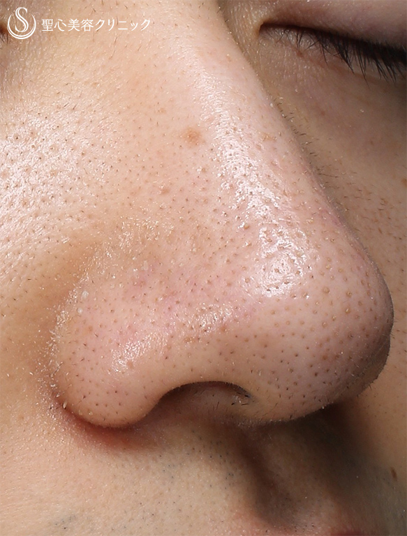 代男性 鼻の毛穴 Picoフラクショナルレーザー 2回処置後 症例写真 美容整形 美容外科なら聖心美容クリニック