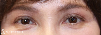 【50代女性・目元をお若く そして綺麗に】眼瞼下垂 切開法（術後4ヶ月） Before 