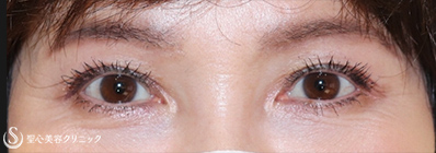 【50代女性・目元をお若く そして綺麗に】眼瞼下垂 切開法（術後4ヶ月） After 