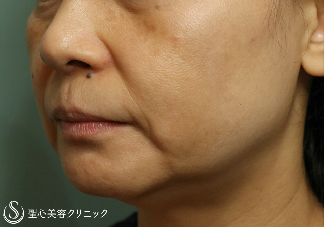 【50代女性・ほうれい線・マリオネットライン】プレミアムPRP皮膚再生療法（7ヶ月後） Before 
