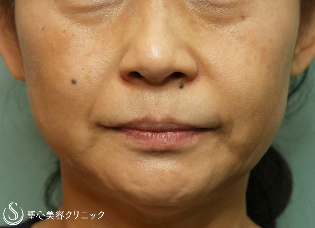 【50代女性・ほうれい線・マリオネットライン】プレミアムPRP皮膚再生療法（7ヶ月後） Before 