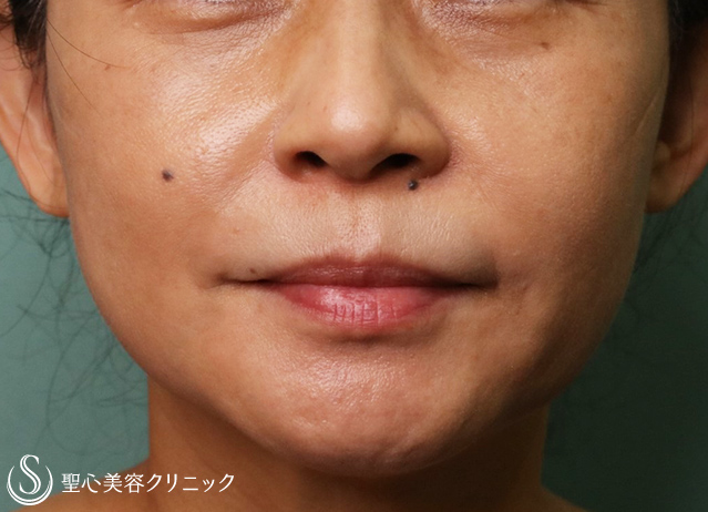 【50代女性・ほうれい線・マリオネットライン】プレミアムPRP皮膚再生療法（7ヶ月後） After 