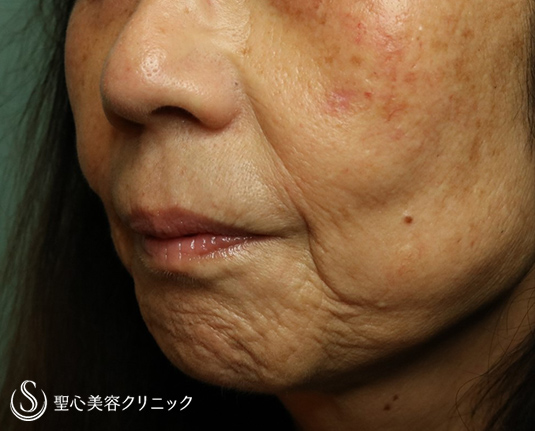 【60代女性・マリオネットライン～あご周りのしわ】プレミアムPRP皮膚再生療法（9ヶ月後）・ボトックス（5ヶ月後） Before 