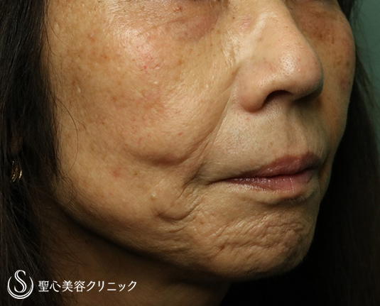 【60代女性・マリオネットライン～あご周りのしわ】プレミアムPRP皮膚再生療法（9ヶ月後）・ボトックス（5ヶ月後） Before 