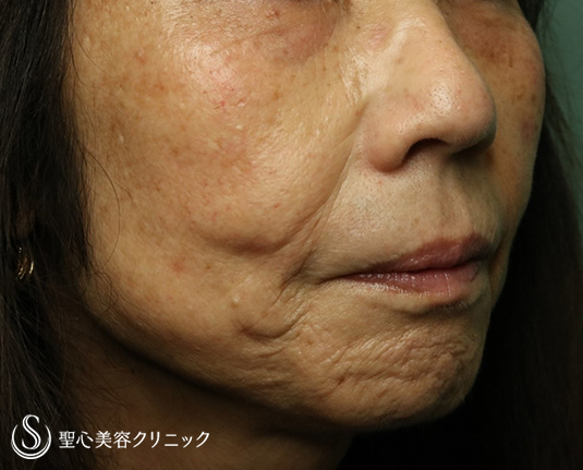 【60代女性・マリオネットライン～あご周りのしわ】プレミアムPRP皮膚再生療法（9ヶ月後）・ボトックス（5ヶ月後） Before 