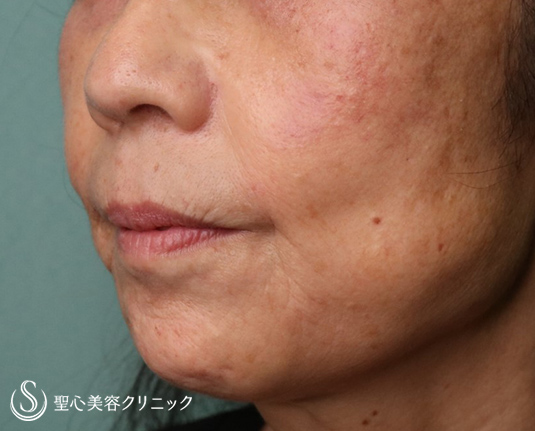 【60代女性・マリオネットライン～あご周りのしわ】プレミアムPRP皮膚再生療法（9ヶ月後）・ボトックス（5ヶ月後） After 
