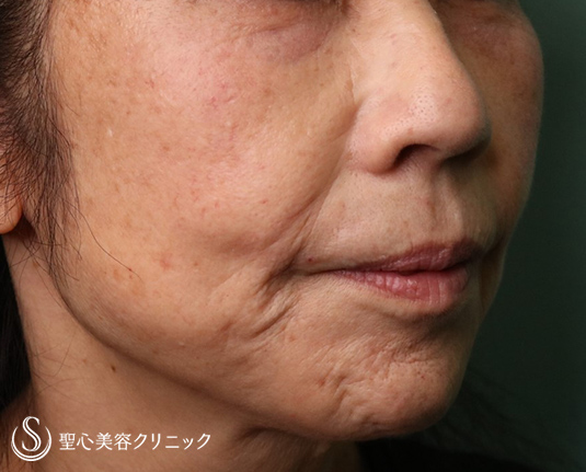 【60代女性・マリオネットライン～あご周りのしわ】プレミアムPRP皮膚再生療法（9ヶ月後）・ボトックス（5ヶ月後） After 