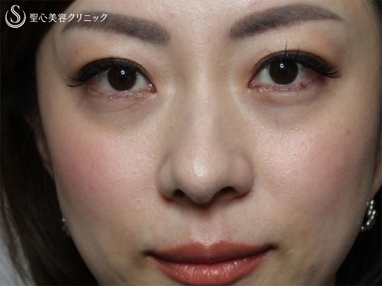 【40の女性・目の下のクマ、たるみ、段差】目の下+法令線のプレミアムPRP（7ヶ月後） 症例写真 美容整形、美容外科なら聖心美容クリニック