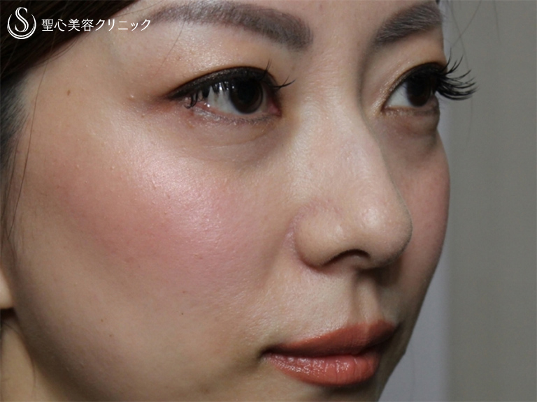 【40の女性・目の下のクマ、たるみ、段差】目の下+法令線のプレミアムPRP（7ヶ月後） 症例写真 美容整形、美容外科なら聖心美容クリニック