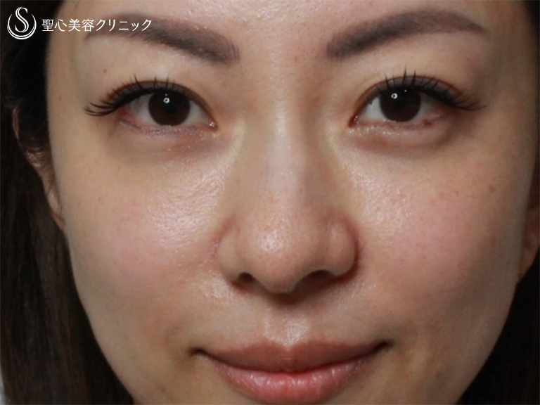 【40の女性・目の下のクマ、たるみ、段差】目の下+法令線のプレミアムPRP（7ヶ月後） 症例写真 美容整形、美容外科なら聖心美容クリニック
