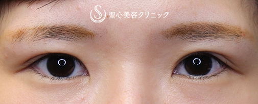 【20代女性・憧れのパッチリ目に！】眼瞼下垂（切開法）＋目頭切開（手術後2ヶ月） After 