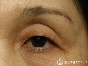 【50代女性・目の上のくぼみ、二重】プレミアムPRP皮膚再生療法、マイクロメソッド（6ヶ月後） Before 