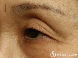 【50代女性・目の上のくぼみ、二重】プレミアムPRP皮膚再生療法、マイクロメソッド（6ヶ月後） Before 