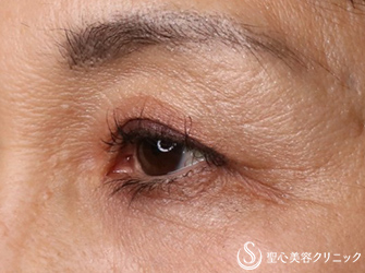 【50代女性・目の上のくぼみ、二重】プレミアムPRP皮膚再生療法、マイクロメソッド（6ヶ月後） After 