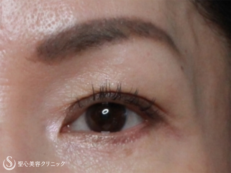 【50代女性・左目の上のくぼみの改善】プレミアムPRP皮膚再生療法（9ヶ月後） After 