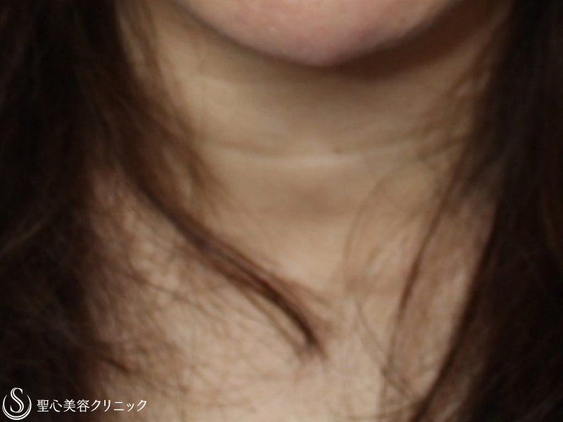 【50代女性・首の横じわの治療】プレミアムPRP皮膚再生療法（2年後） Before 